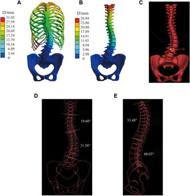 Material sensitivity of patient-specific finite element models in the brace treatment of scoliosis